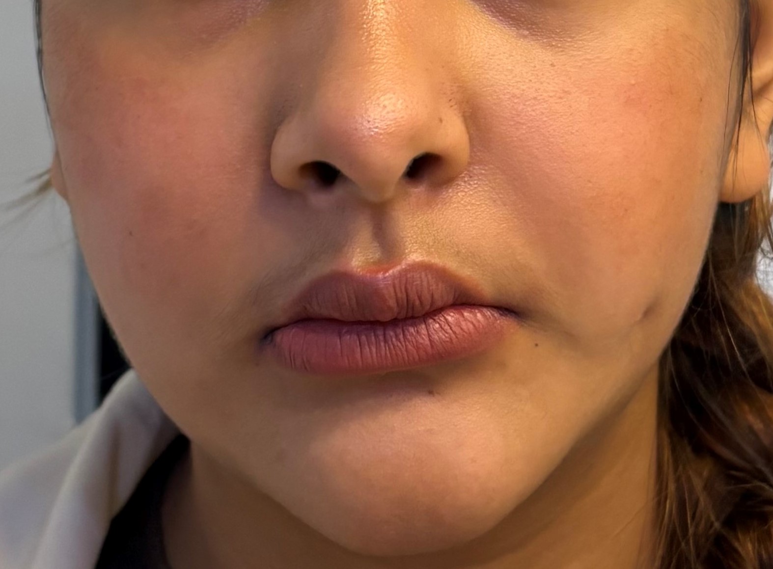 Before Facial Fat Grafting