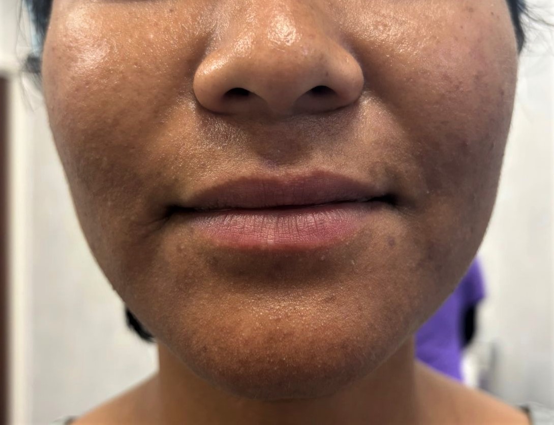 Before Lip Lipoaugmentation