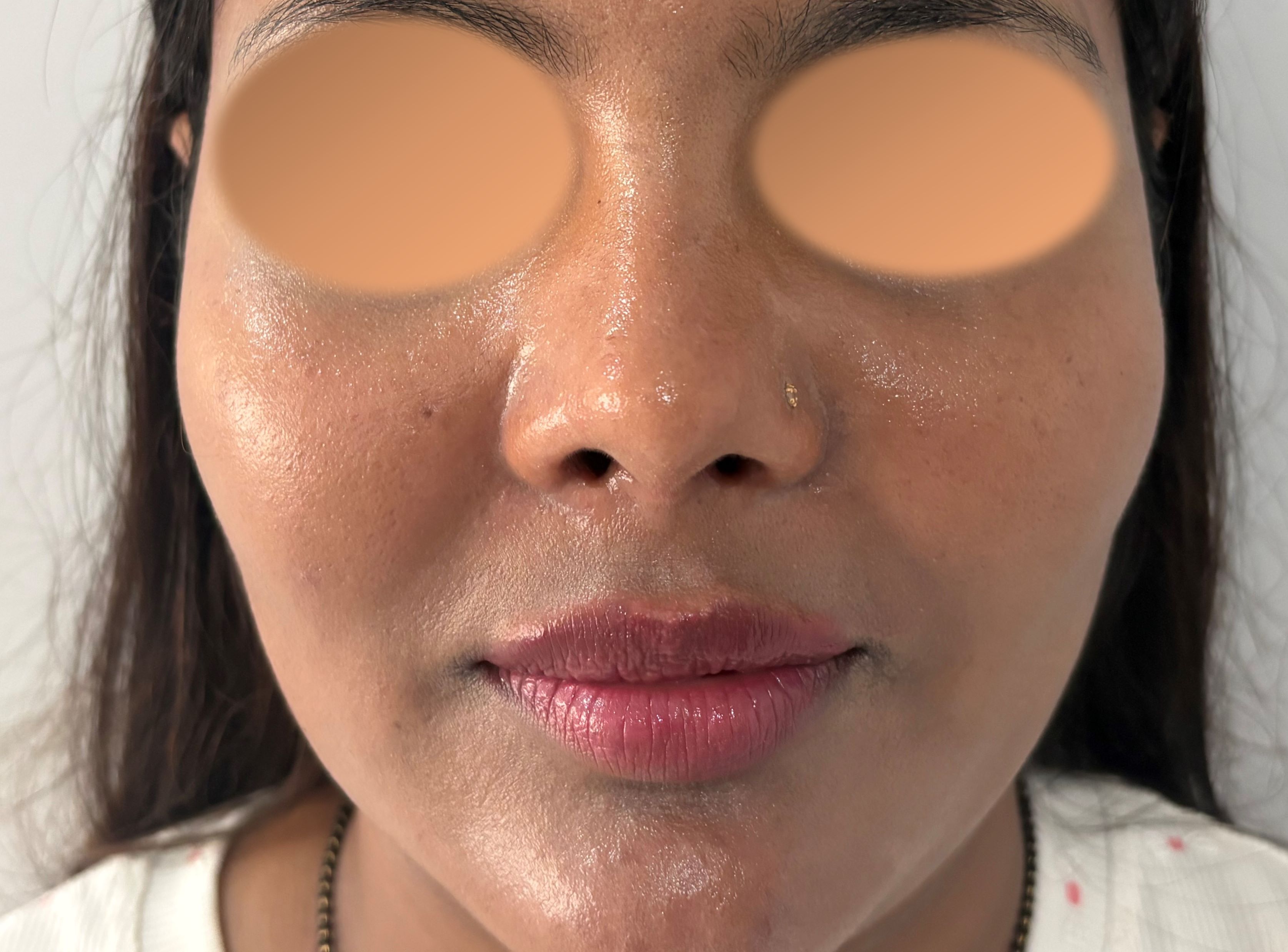 After Rhinoplasty