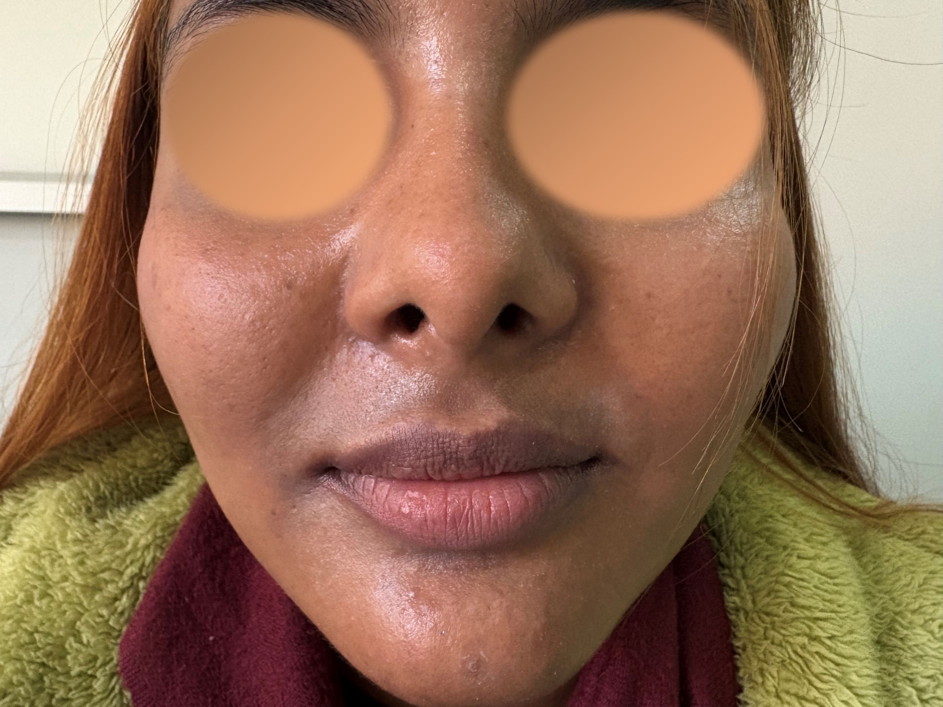 Before Rhinoplasty