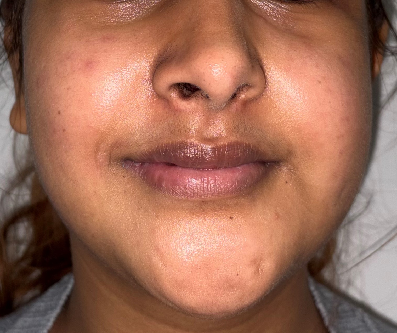 After Facial Fat Grafting
