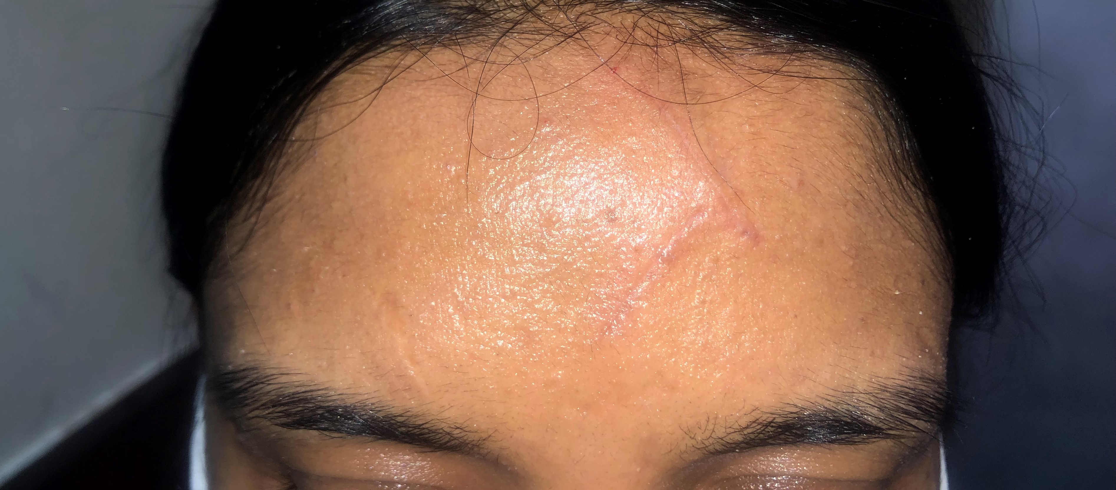 After scar revision