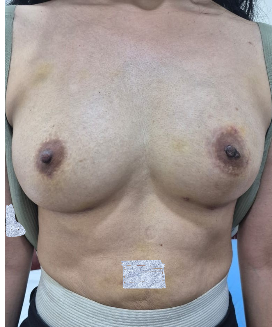 After Breast Surgery