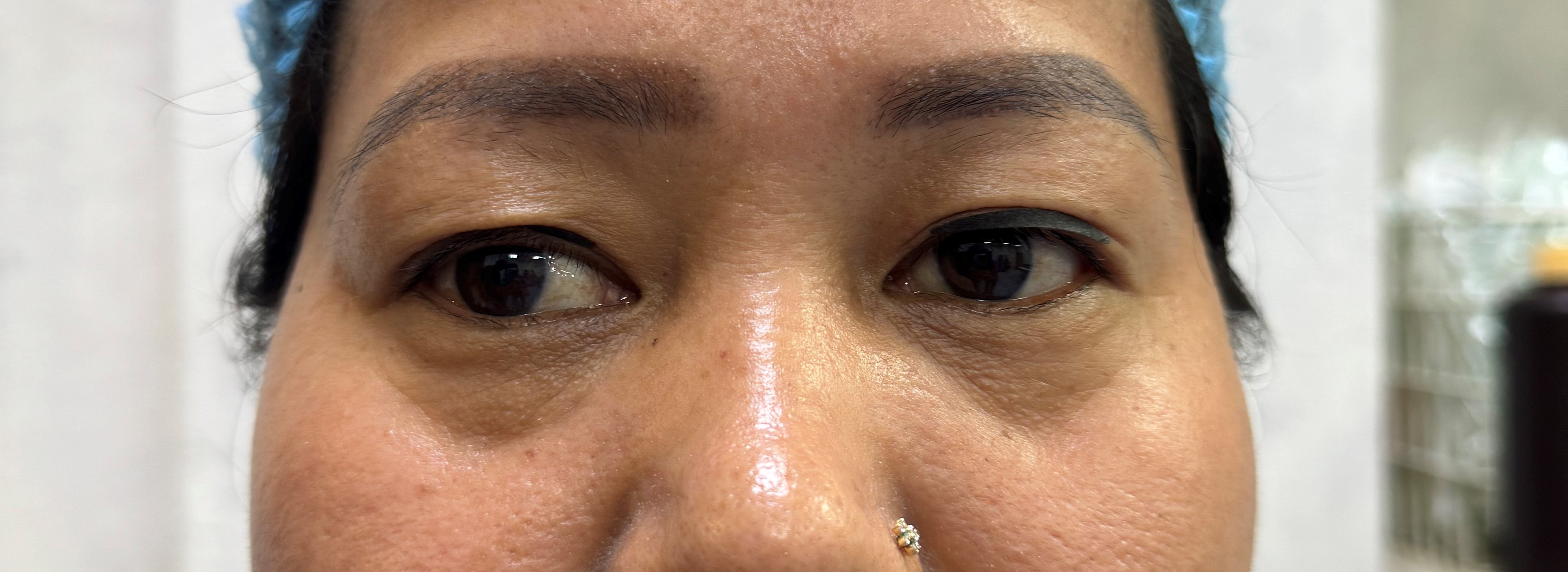 Before Uppre Blepharoplasty