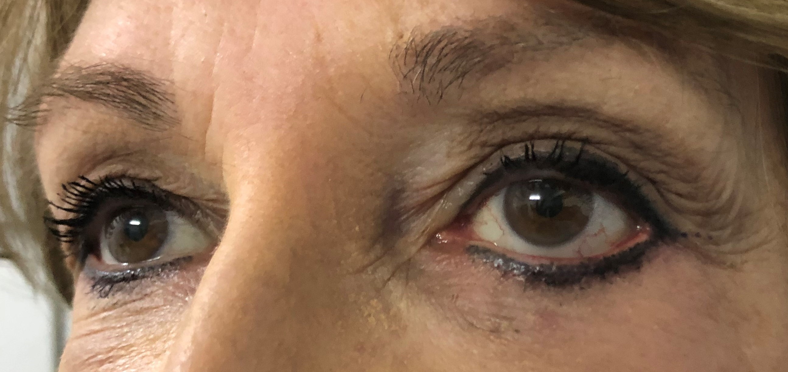 Before Ectropion repair - lateral canthopexy