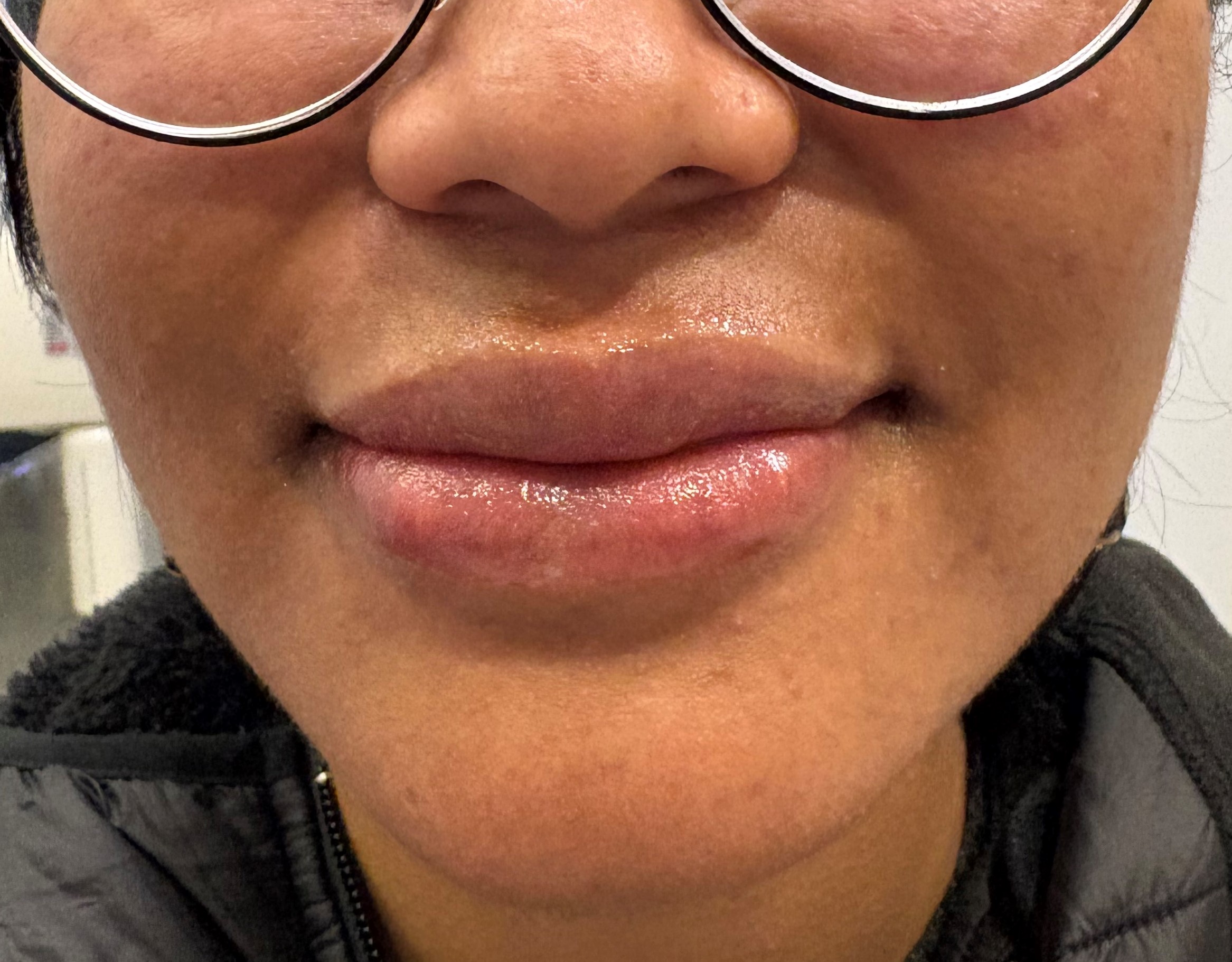 After Lip Lipoaugmentation