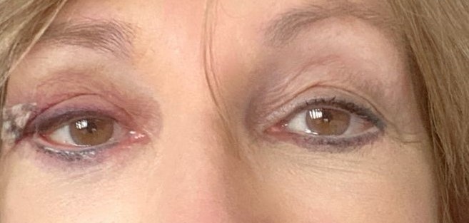 After Ectropion repair - lateral canthopexy