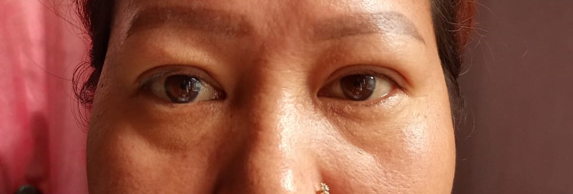After Uppre Blepharoplasty