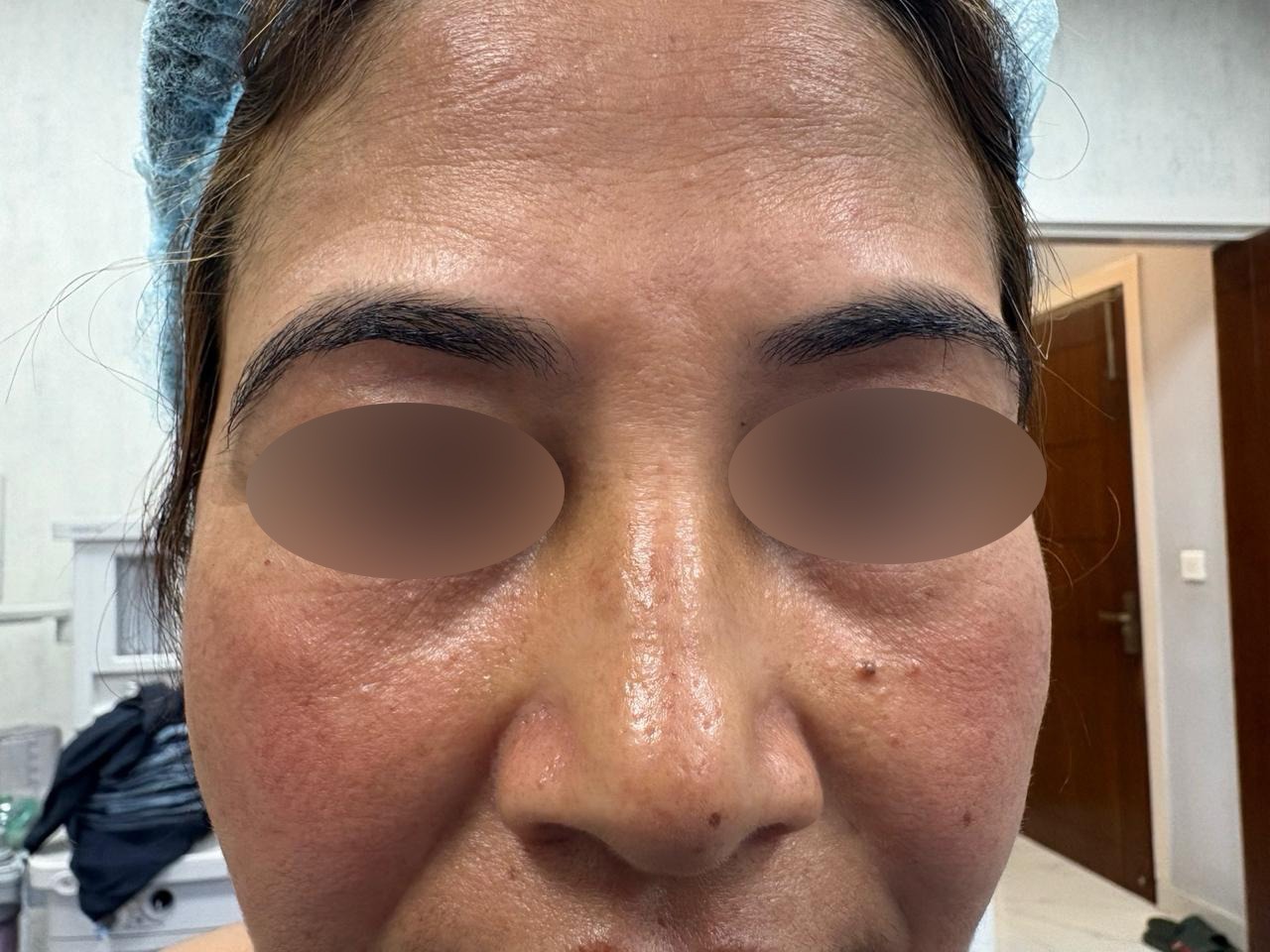 Before Browpexy
