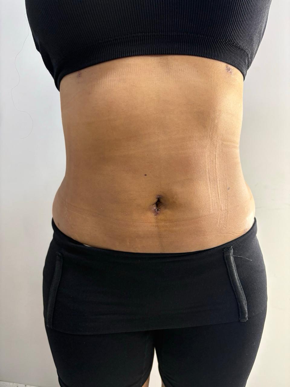 After liposuction