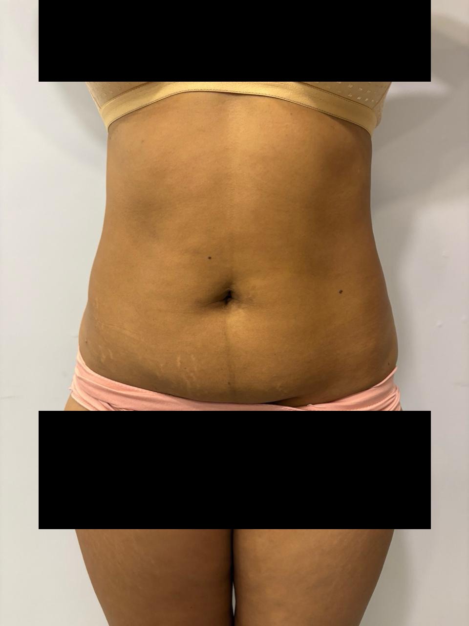 Before liposuction
