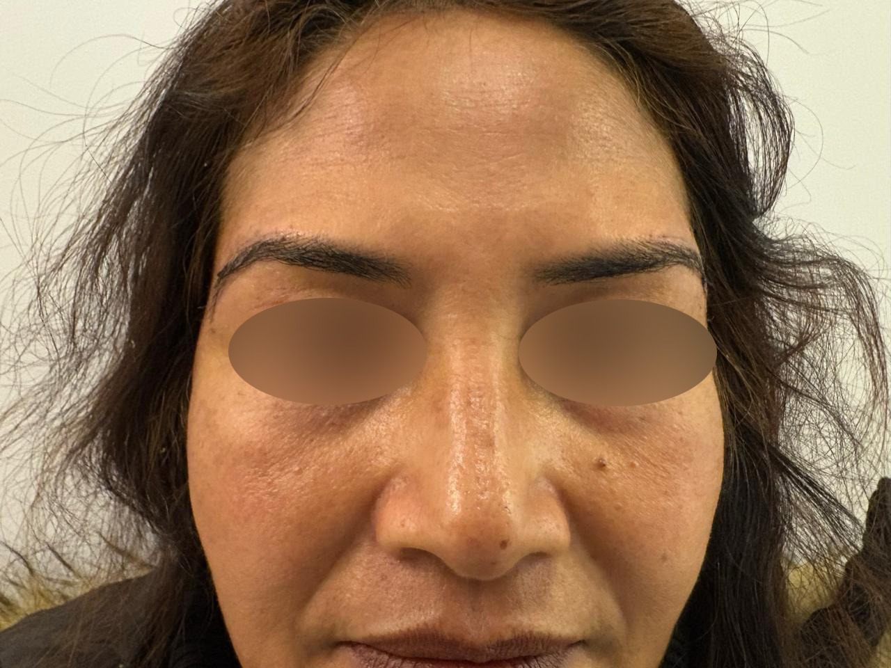 After Browpexy