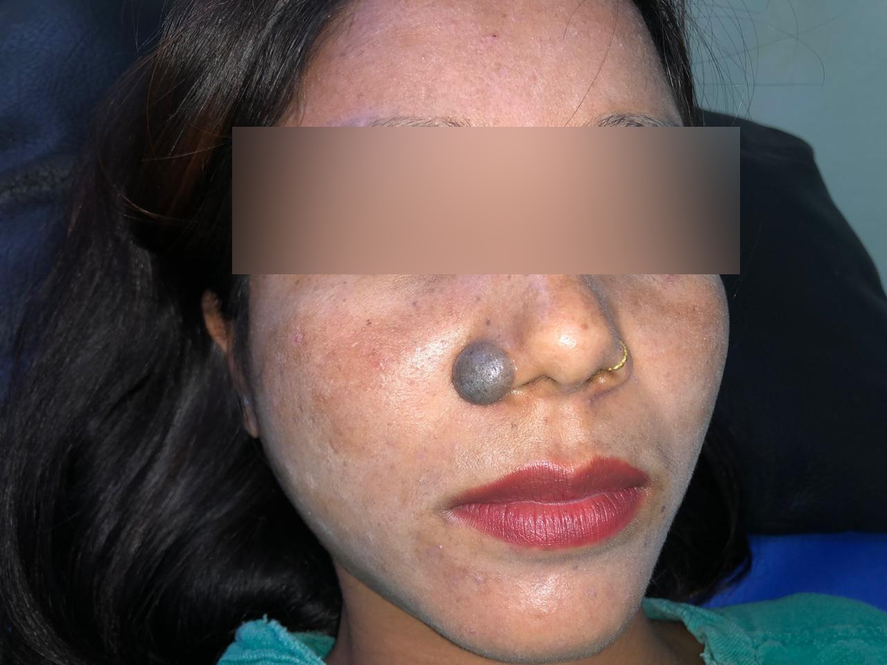 Before Mole Removal