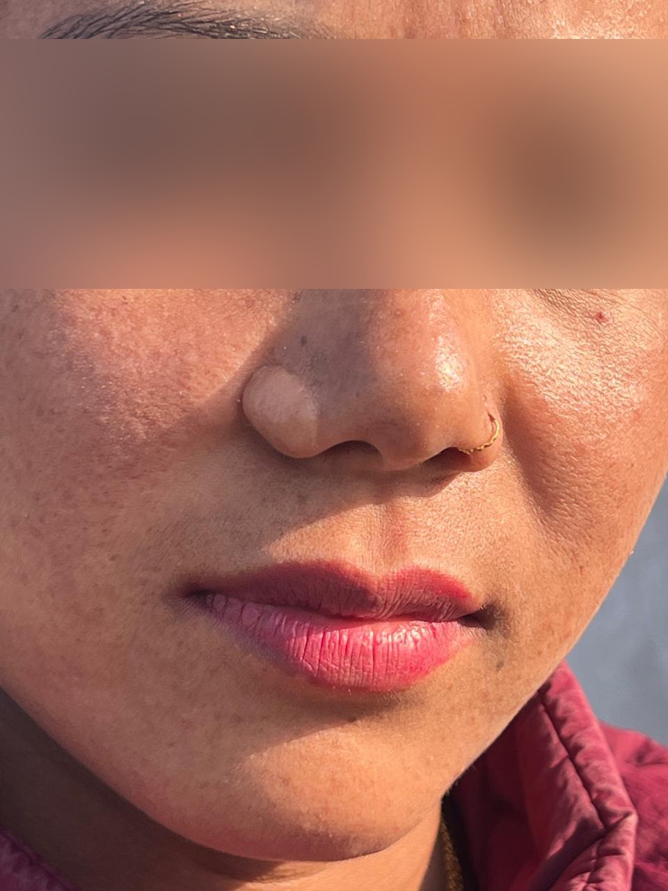 After Mole Removal