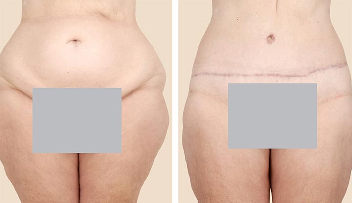 Liposuction (Abdomen, Thighs, Legs, Arms, Buttocks)