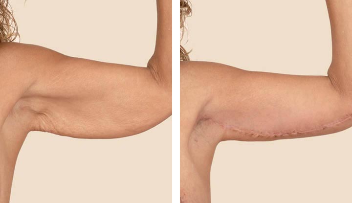 Brachioplasty / Arm Reduction Surgery