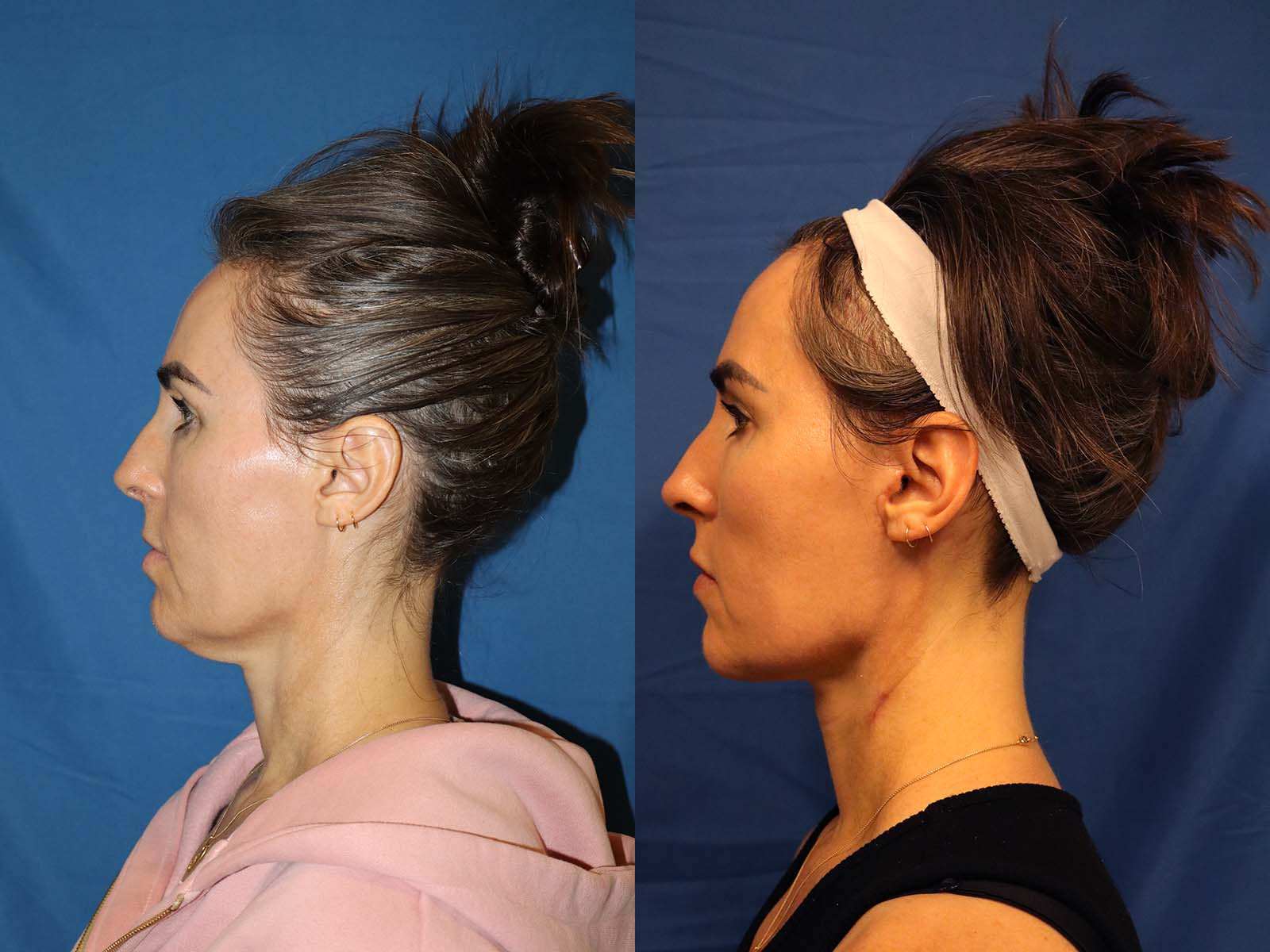 Neck Lift