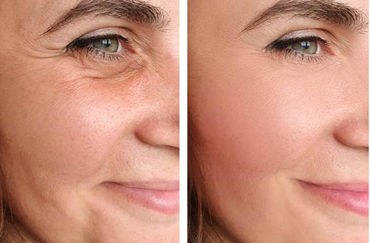 Face Lift
