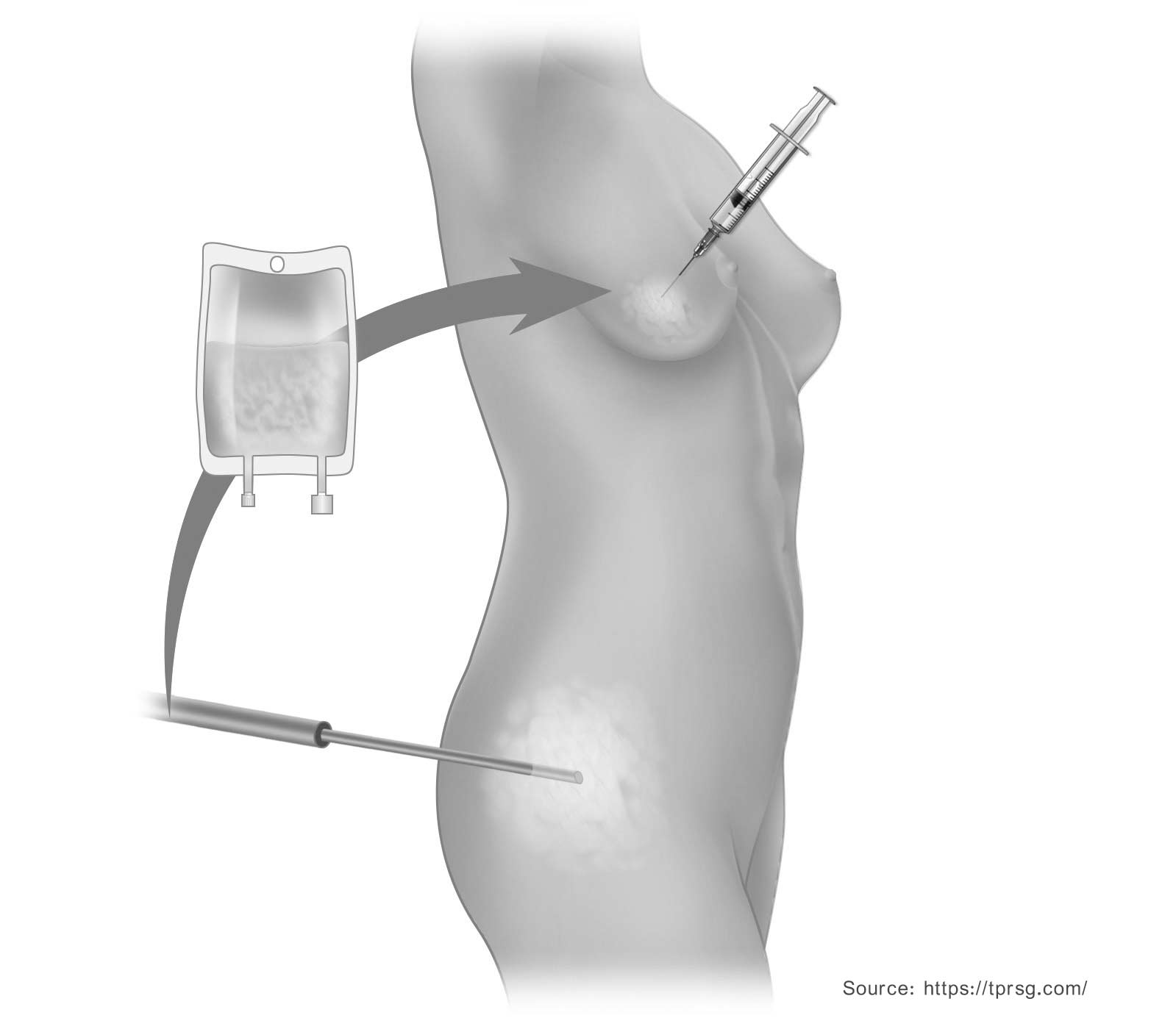Breast Augmentation with Fat Grafting
