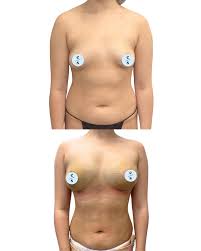 Liposuction of Breast