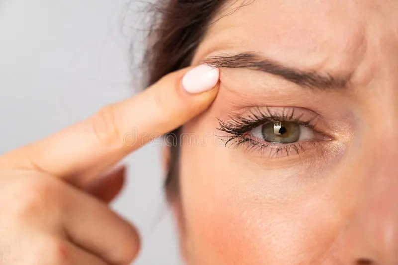 Upper Blepharoplasty