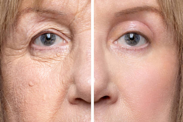 Lower Blepharoplasty