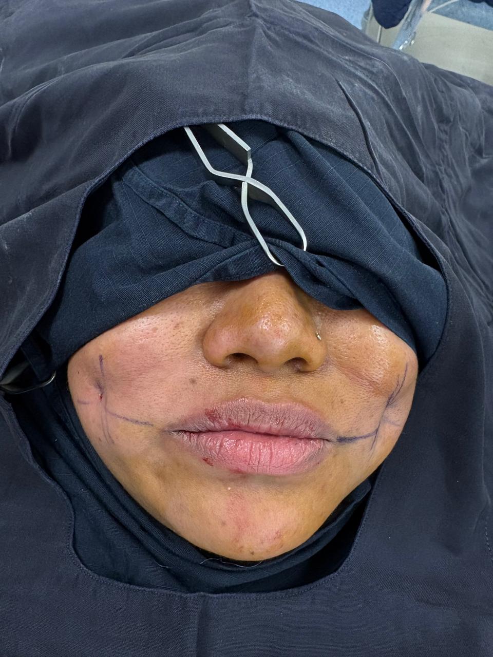 Dimpleplasty