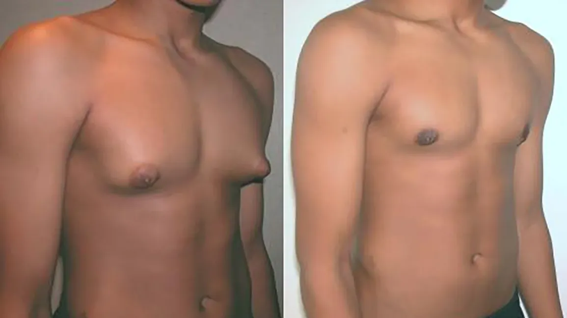 Gynaecomastia Treatment