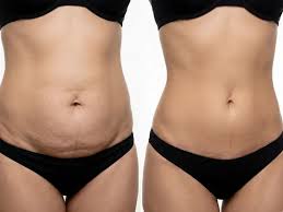 Abdominoplasty / Tummy Tuck