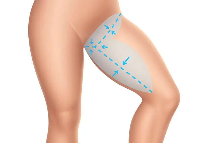 Thighplasty / Thigh Reduction Surgery