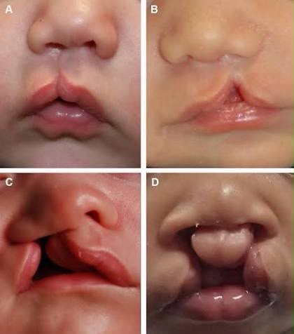 Cleft Lip & Palate Repair