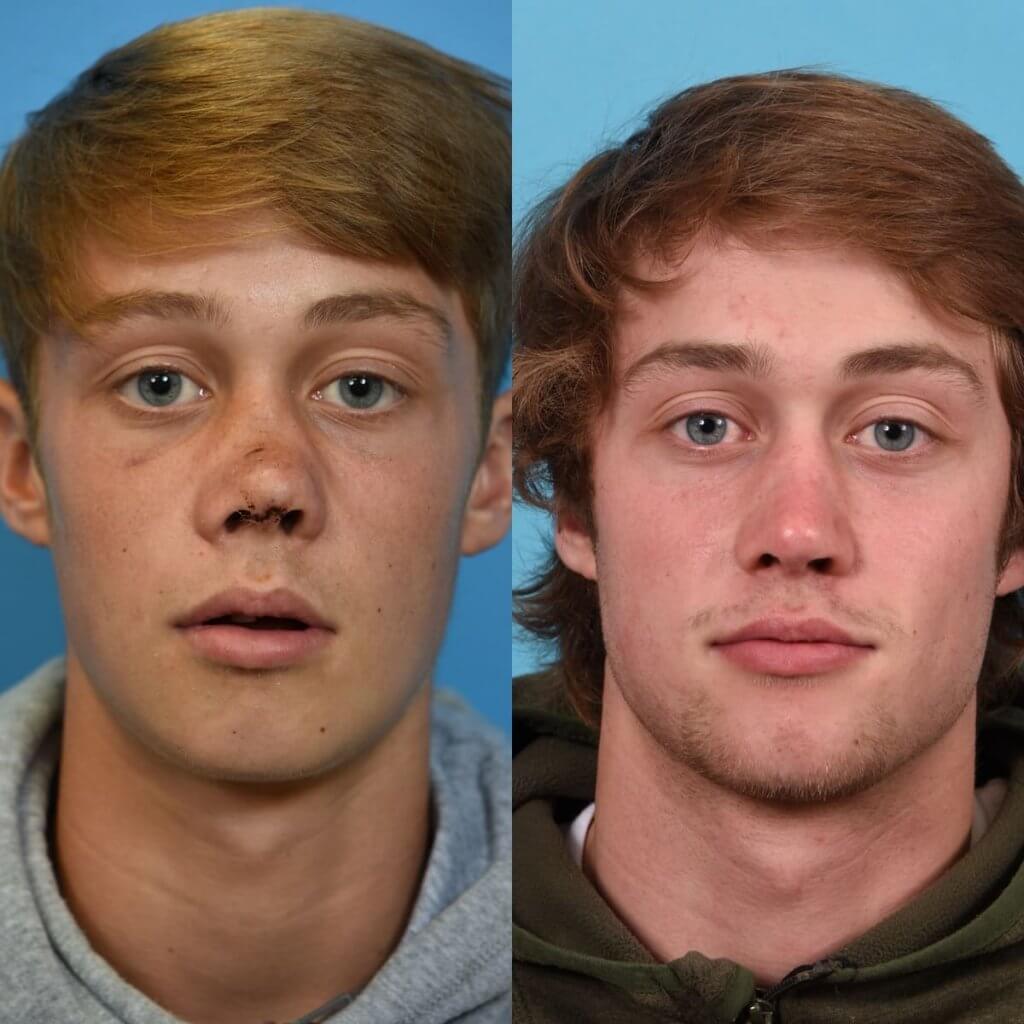 Facial Reconstruction