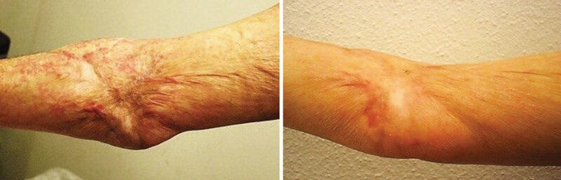 Burn & Scar Revision