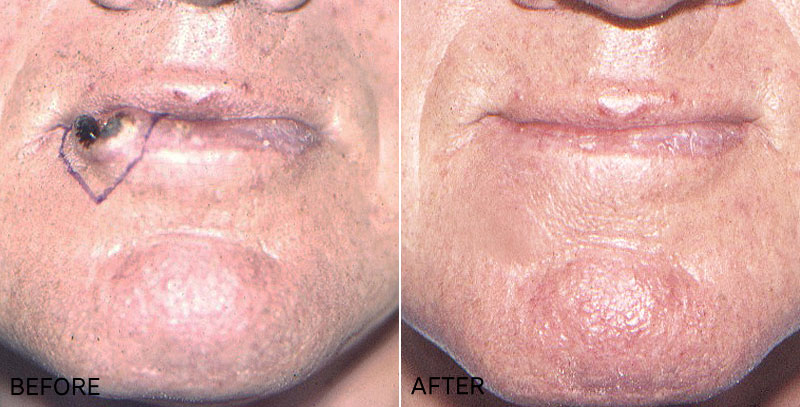 Skin Cancer Removal & Reconstruction