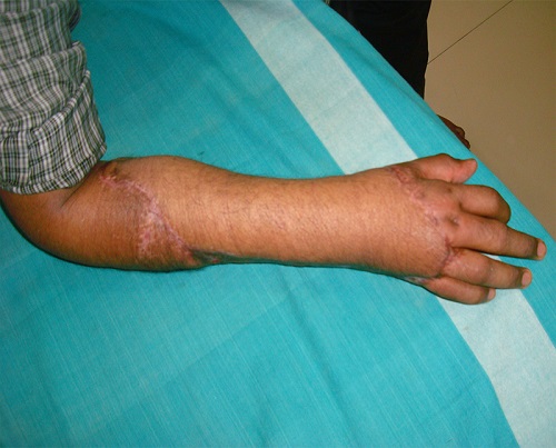 Hand & Limb Reconstruction